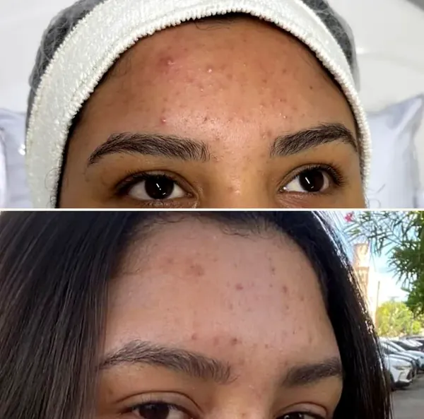Pele da testa com acne, antes e depois dos cuidados