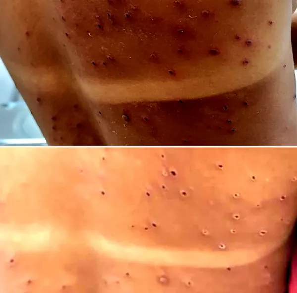 Lesões de pele nas costas, antes e depois do tratamento