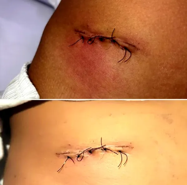 Ferida operatória com pontos, antes e depois do acompanhamento