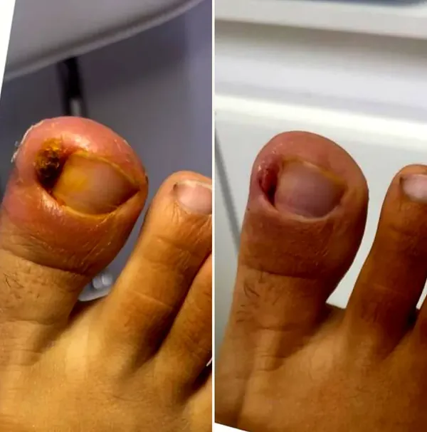 Unha encravada com inflamação no hálux, antes e depois do tratamento