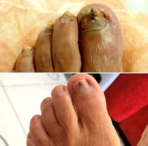 Unhas dos pés com alterações, antes e depois dos cuidados